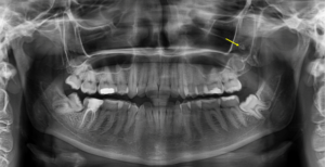 maxiliary sinus